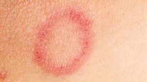 gombás bőrfertőzés kezelése házilag klinikai helminthiasis