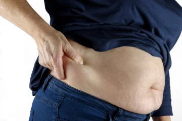 Elhízás- mikor van szükség gyógyszeres kiegészítésre?