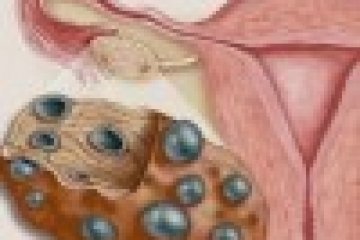PCOS: okok, tünetek, kezelés