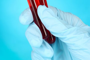 Ezek a hormonális eltérések fordulnak elő gyakran az IR mellett