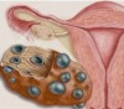 PCOS: okok, tünetek, kezelés
