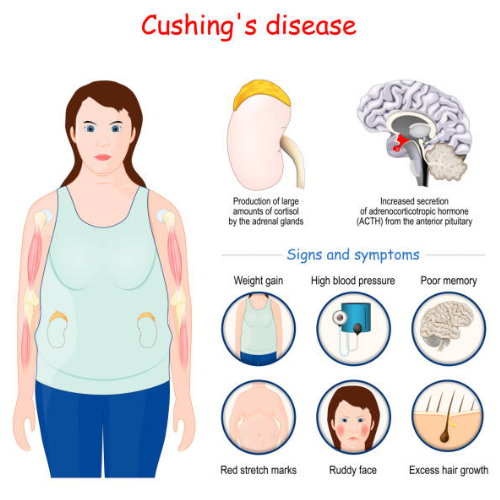 Cushing szindróma