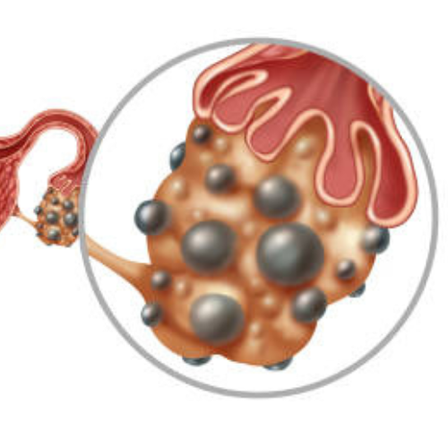 PCOS - Endokrin Központ