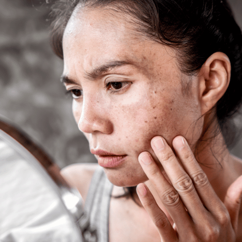 Pigmentfoltokat hormonzavar is okozhat