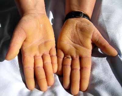 a kezeken a foltok pirosak interaura kezelse s a pikkelysmr megelzse