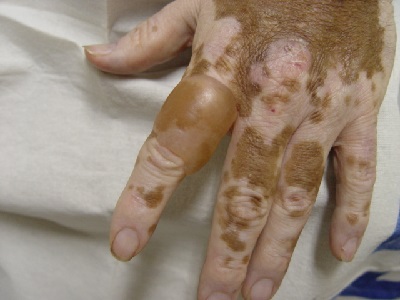 Vitiligo tünetei és kezelése